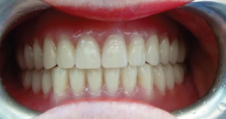 A wax try-in denture with teeth being tried in the patient's mouth so the dentist can check the smile and bite