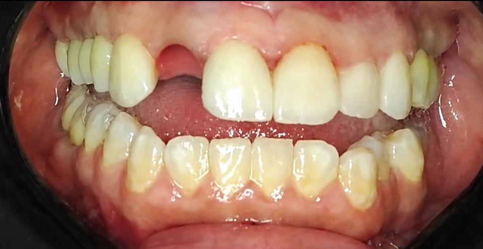 Before treatment — gap between upper front teeth