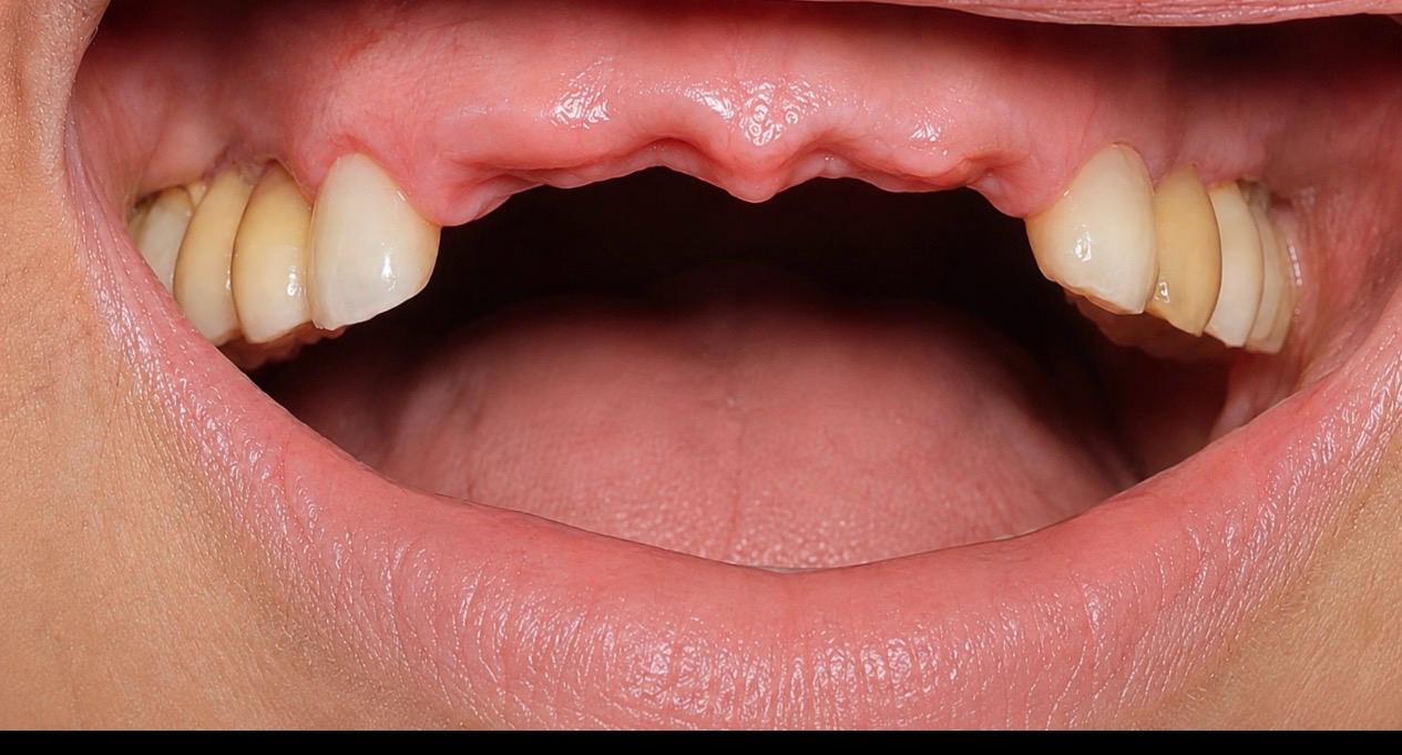 Before implant treatment — missing upper front teeth