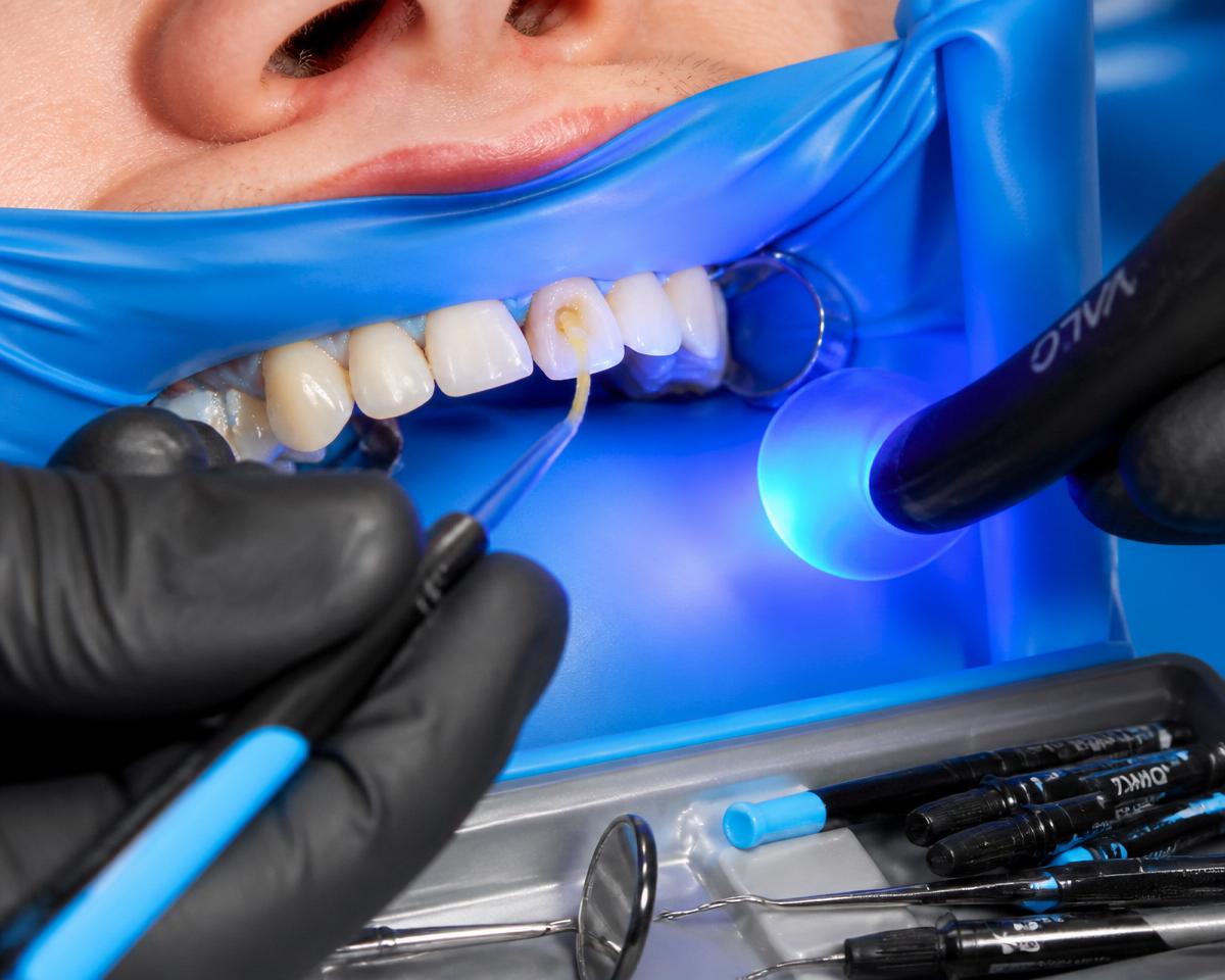 Close-up of a dentist applying bonding agent to a prepared tooth with blue curing light nearby