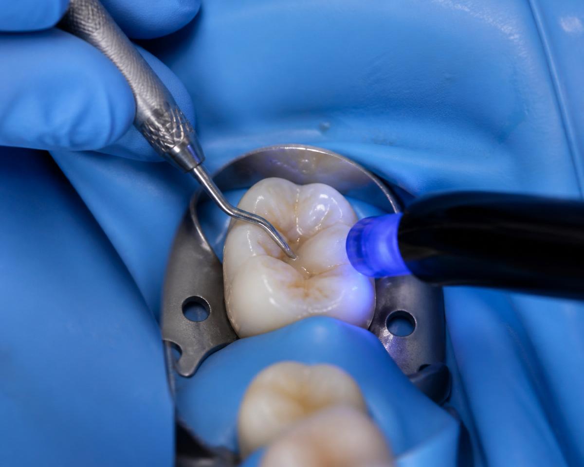 Tooth-coloured composite being placed into a cavity under a rubber dam with blue curing light
