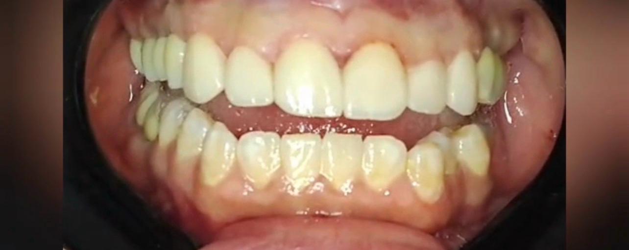 After treatment — even, closed upper front teeth