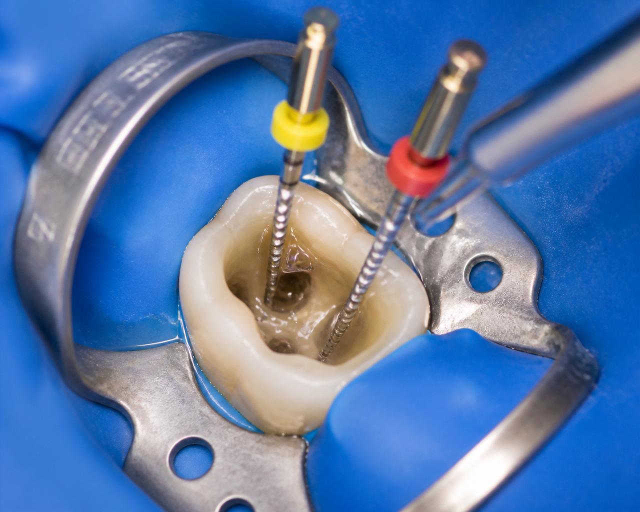 Endodontic files cleaning root canals of a molar isolated with blue rubber dam