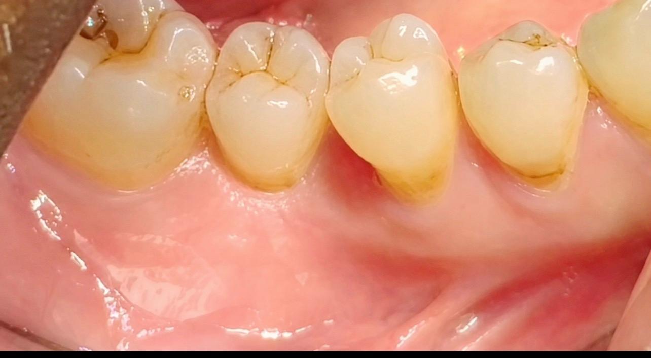 After implant treatment — single implant crown fitted