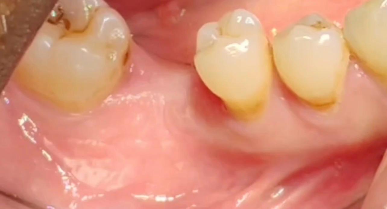 Before implant treatment — single missing lower molar