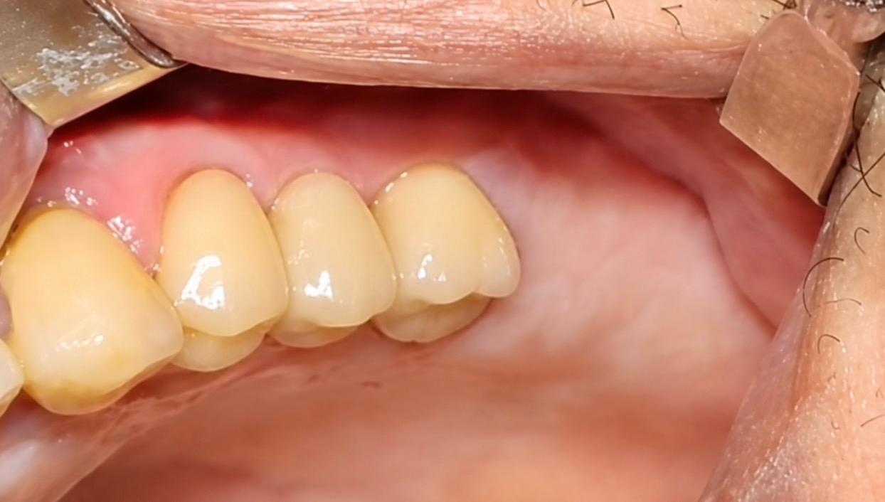 After implant treatment — back teeth restored