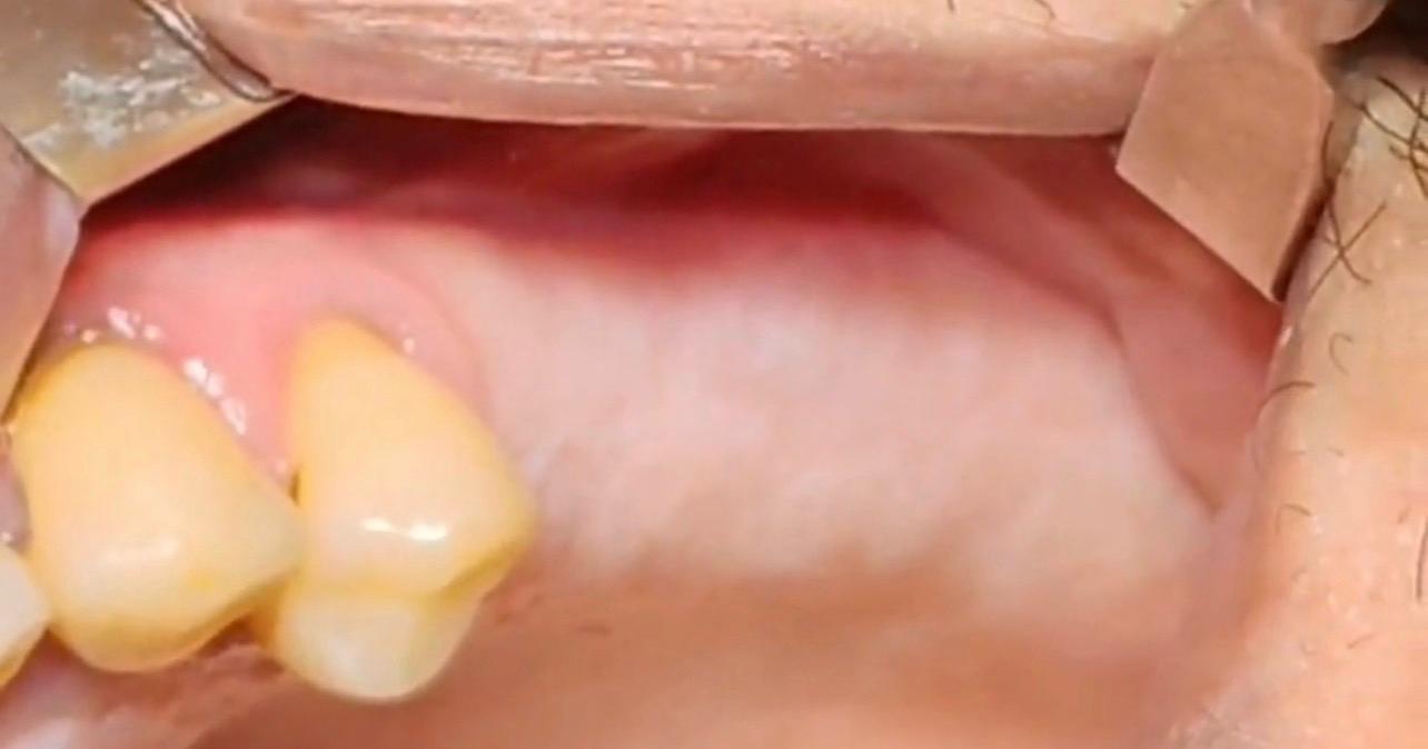 Before implant treatment — missing back teeth