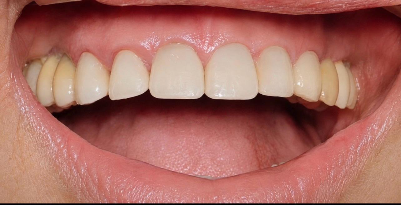 After implant treatment — restored upper front teeth
