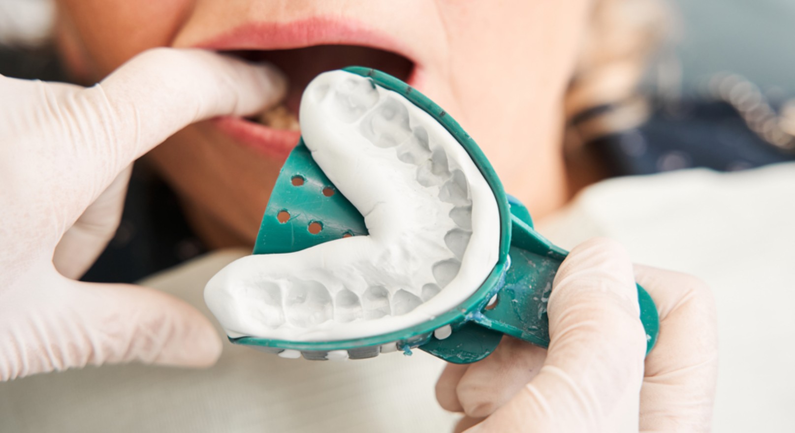 Dentist taking upper and lower impressions using an impression tray filled with pink material