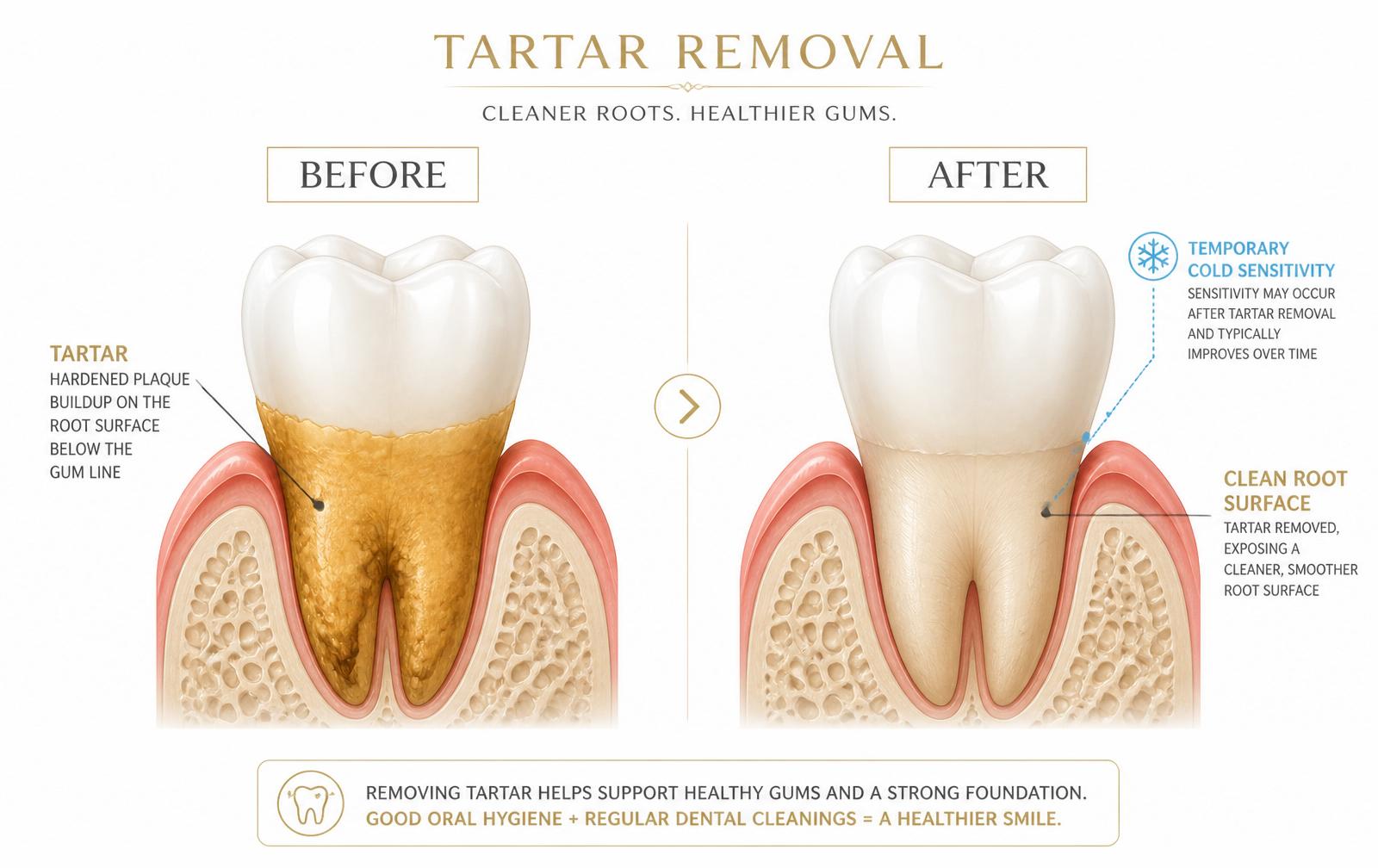 Illustration showing tartar covering the root surface before scaling and the clean root surface afterwards