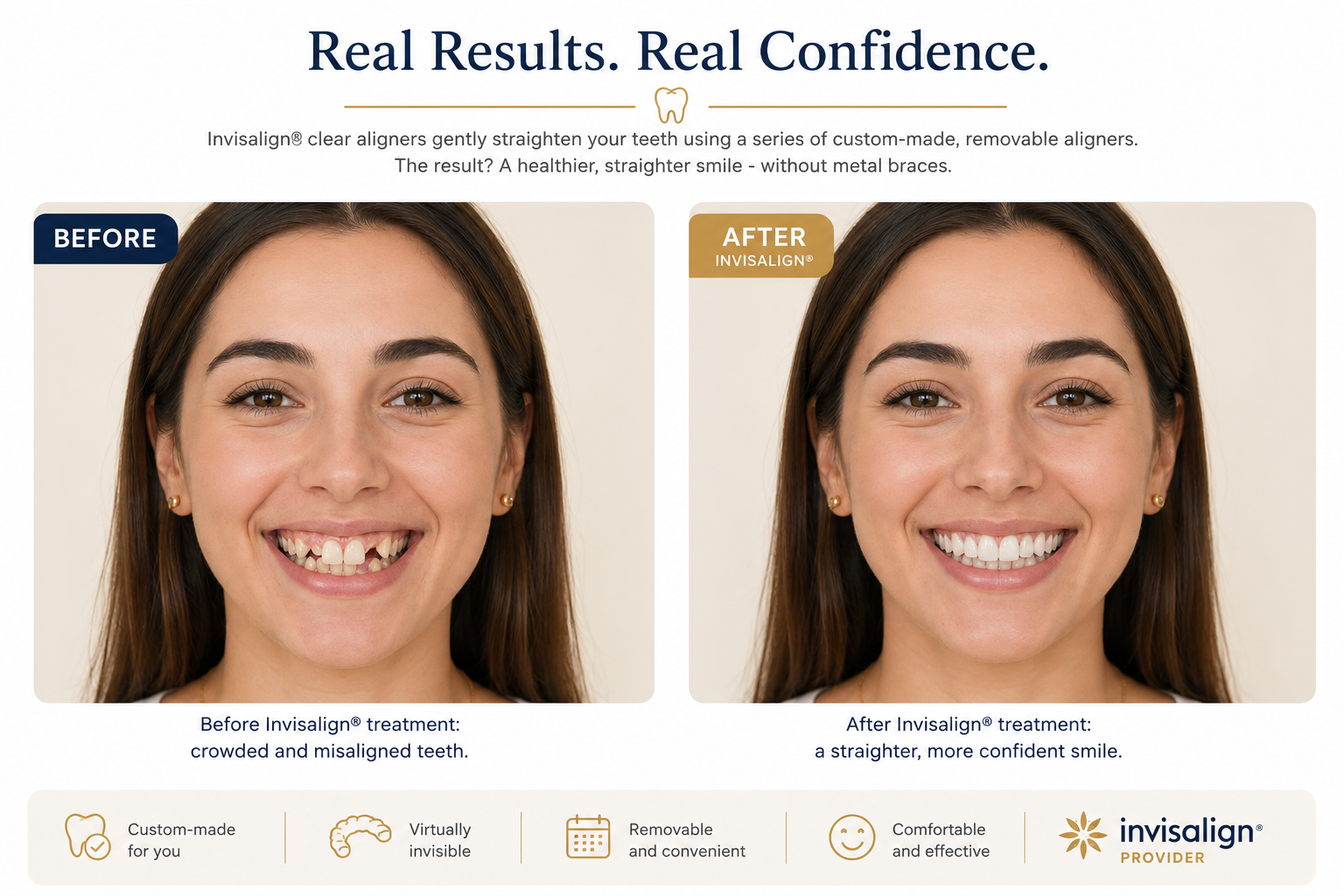 Before and after photograph showing crowded teeth transformed into a beautifully straight smile with Invisalign clear aligners