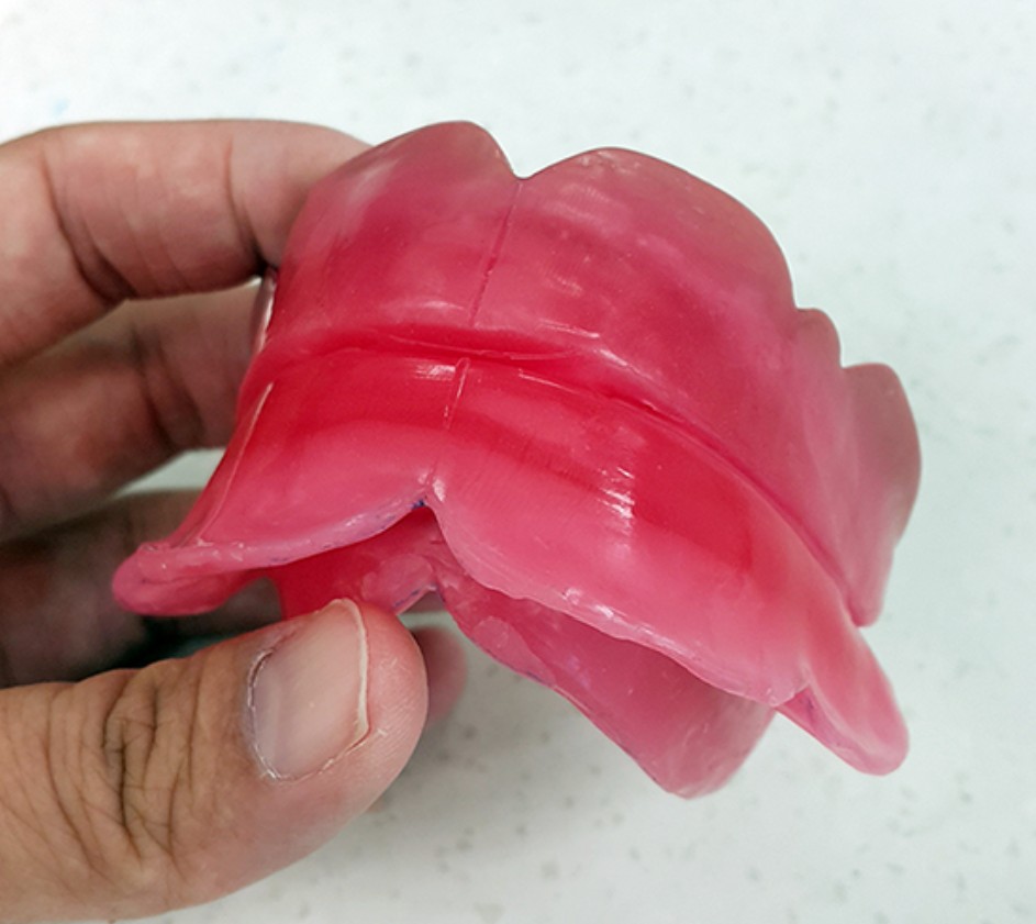 Wax bite registration blocks being placed inside a patient's mouth to record the jaw relationship